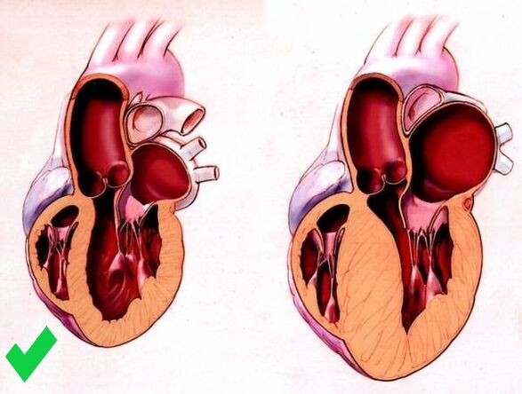 Cardione preprečuje ventrikularno hipertrofijo srca